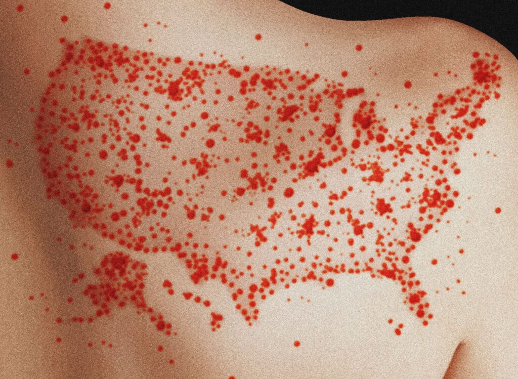 Scientists Find Measles Likely To Become Endemic in the US Over Next 20 Years 9 science measles GettyImages 2163958662 R2z3HC